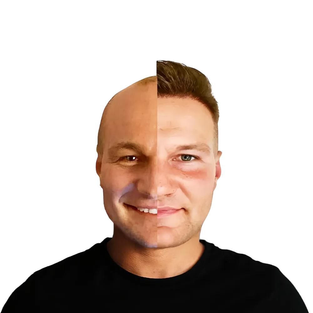 migliore trapianto di capelli in turchia