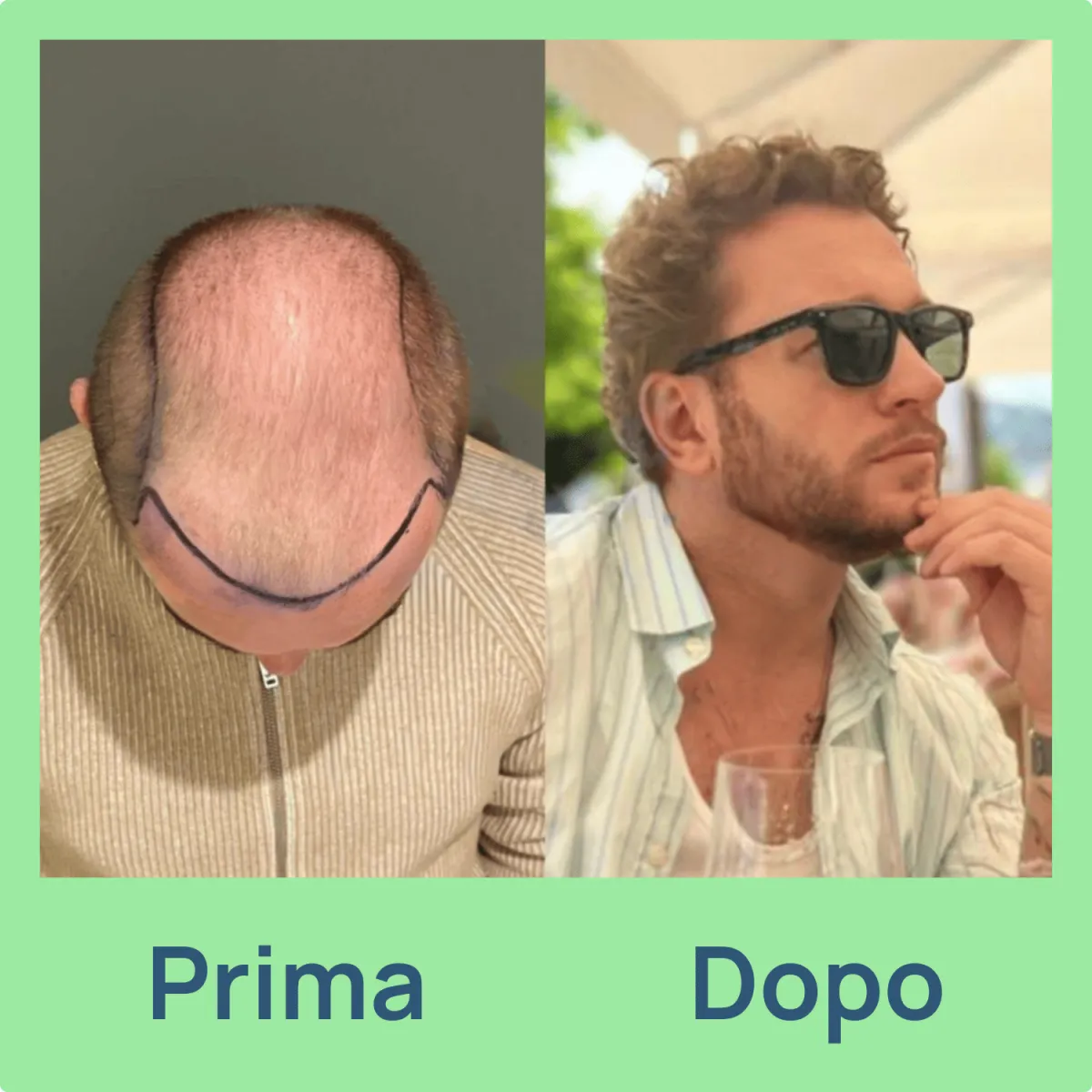 prima e dopo trapianto di capeli