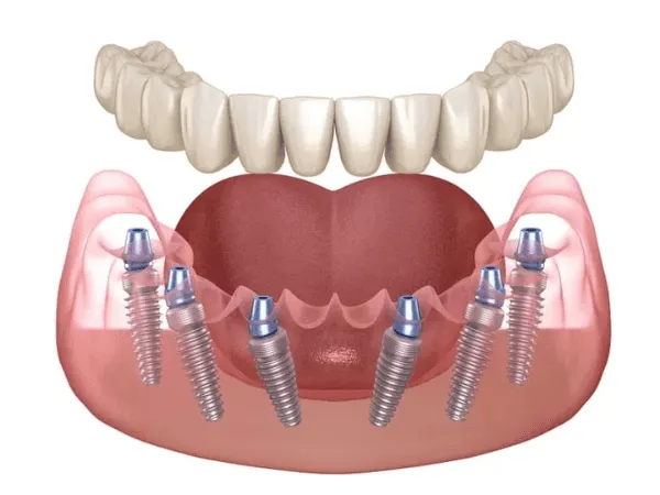 impianti dentali all on 4
