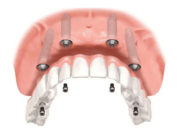 impianti dentali all on 6