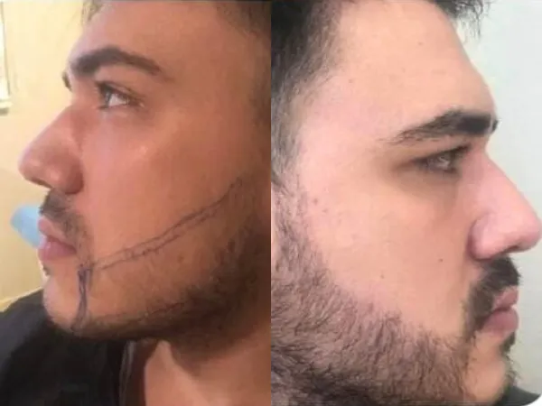 impianti dentali all on 6