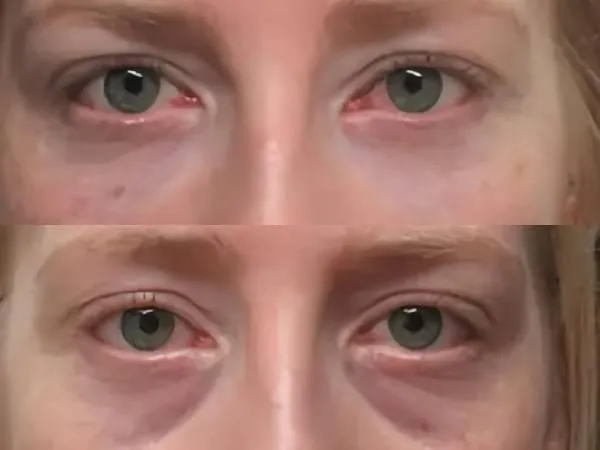 impianti dentali all on 4