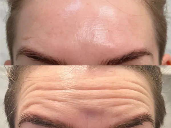 impianti dentali all on 6