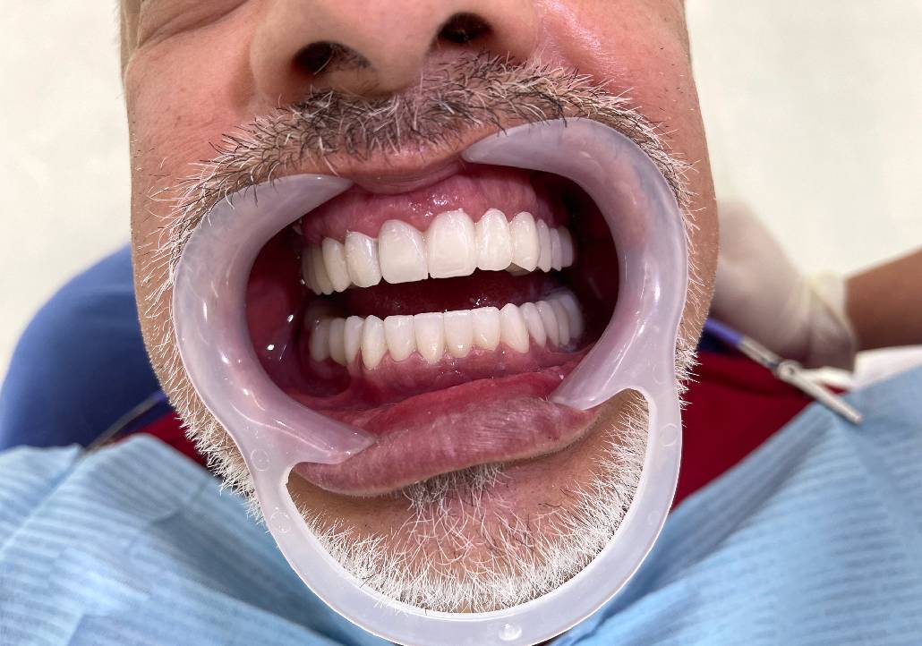 protesi dentali in albania