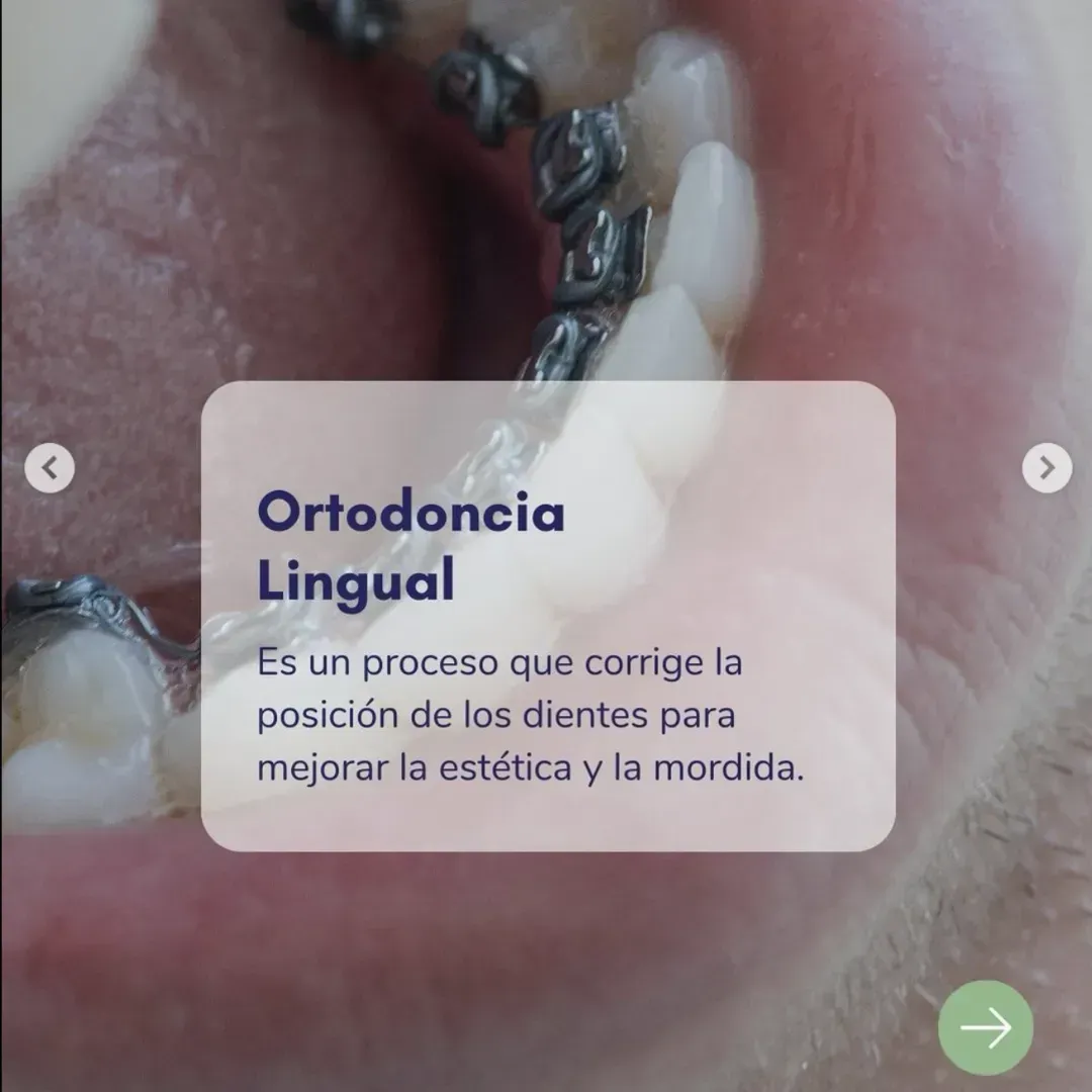 ortodoncia, alineadores invisibles, ortodoncia invisible, frenillos linguales, brackets invisibles, alineadores, ortodoncia lingual, brackets linguales, clinica dental las condes, clínica dental santiago