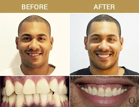 Before After Image