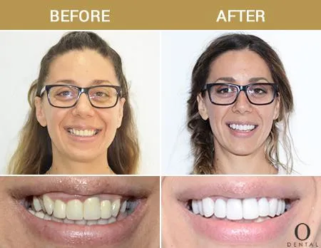 Before After Image