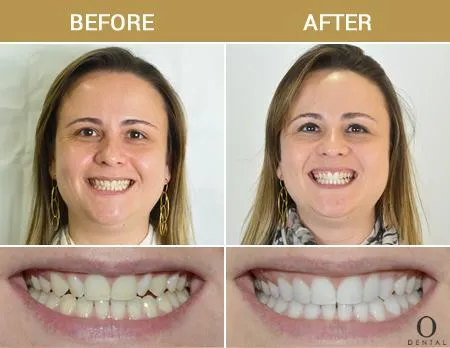 Before After Image