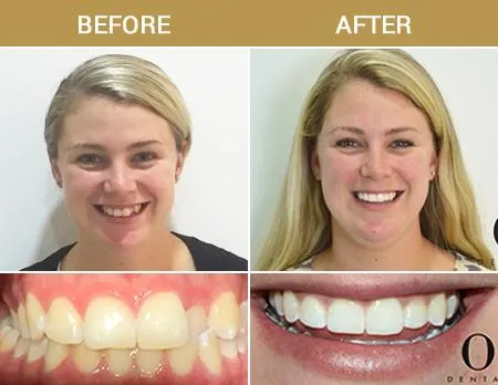 Before After Image