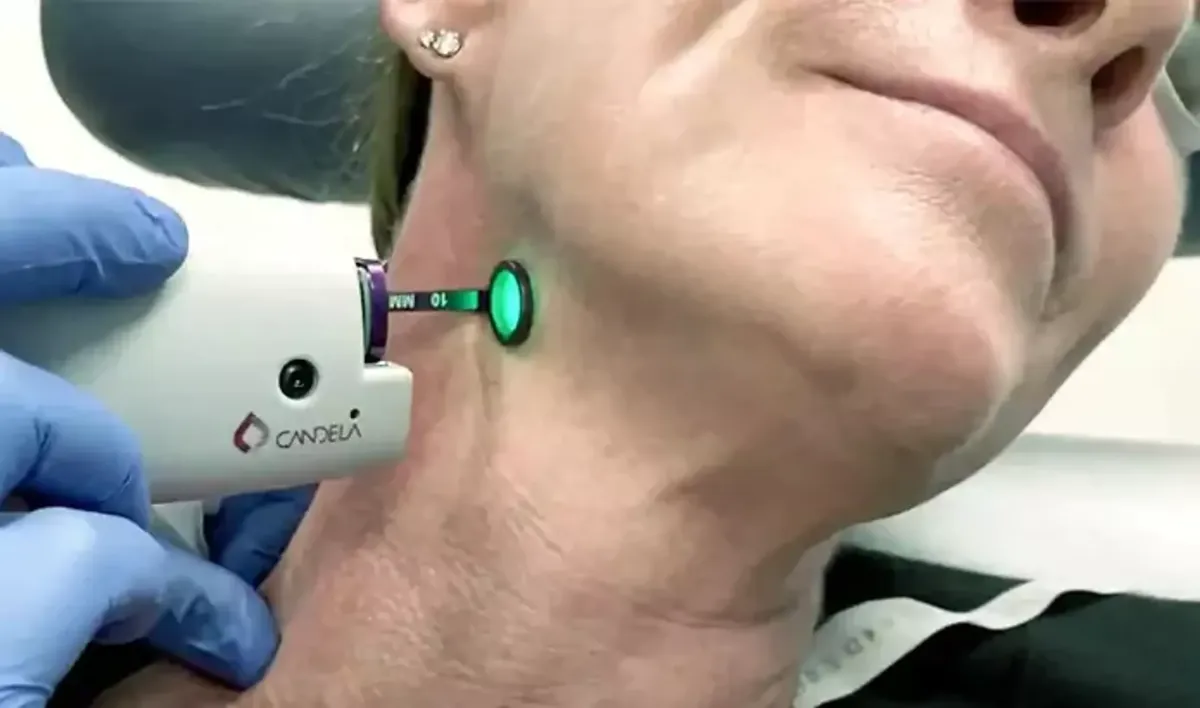 Vascular Lesion Removal in houston tx