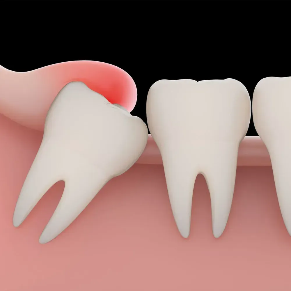 Dental Implants & Dentures