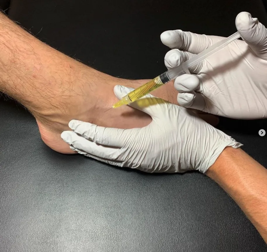 Foot getting a PRP injection by a chiropractor in salt lake city