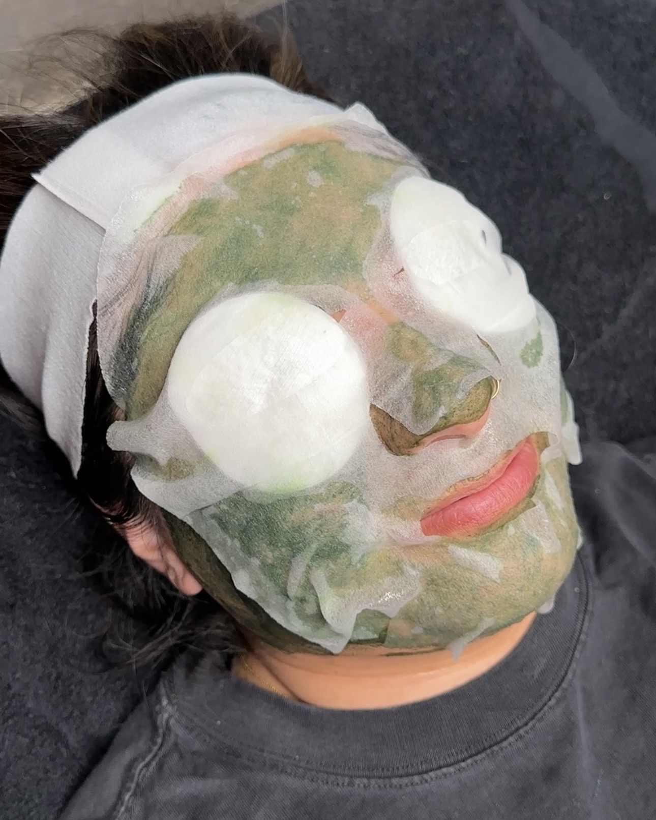 Chemical peel for hyperpigmentation in Long Beach CA