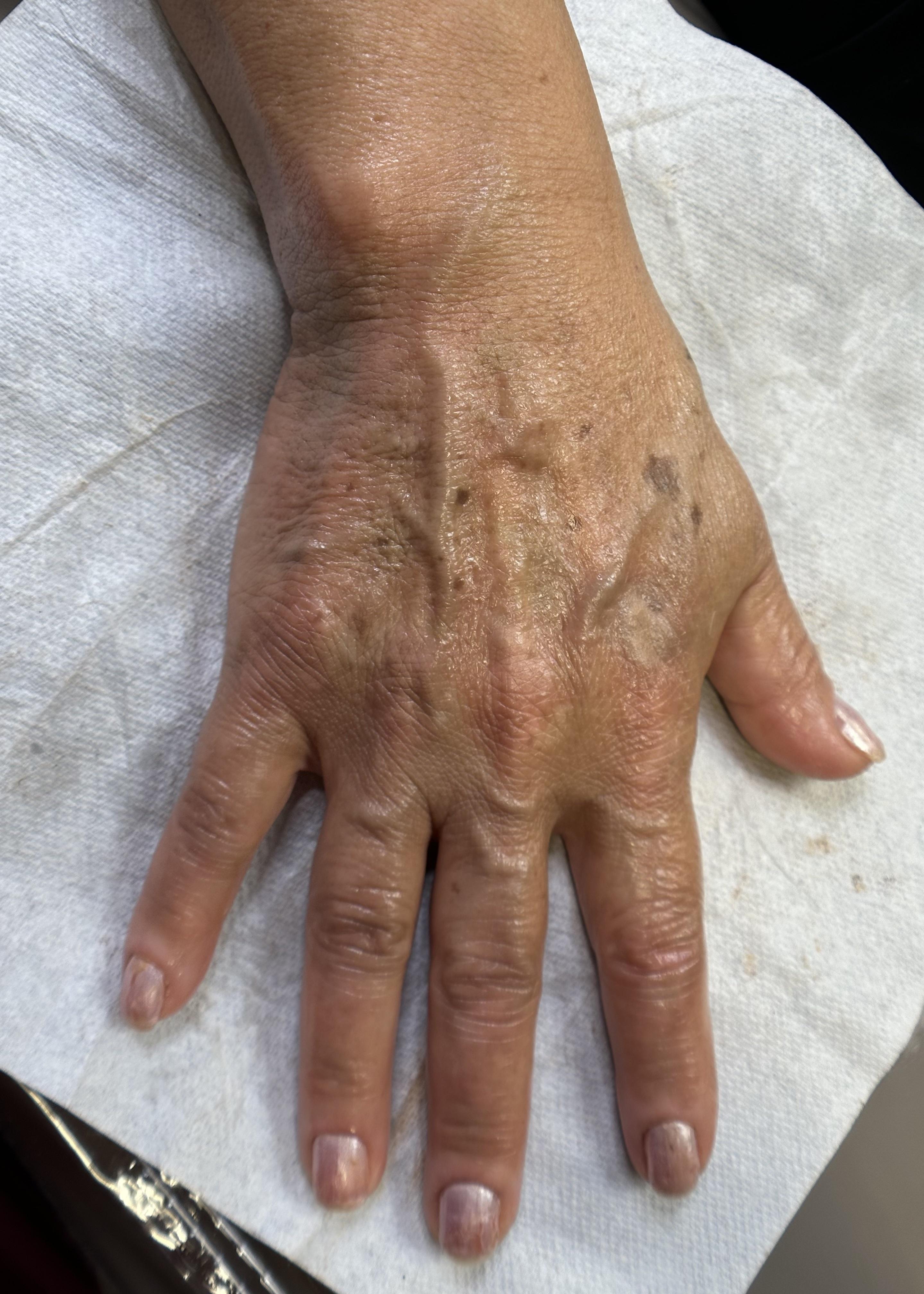 paramedical tattoo stretch mark camouflage vitiligo scar treatment discolored skin help in Long Beach Ca near Lakewood CA near Cerritos CA orange county la county