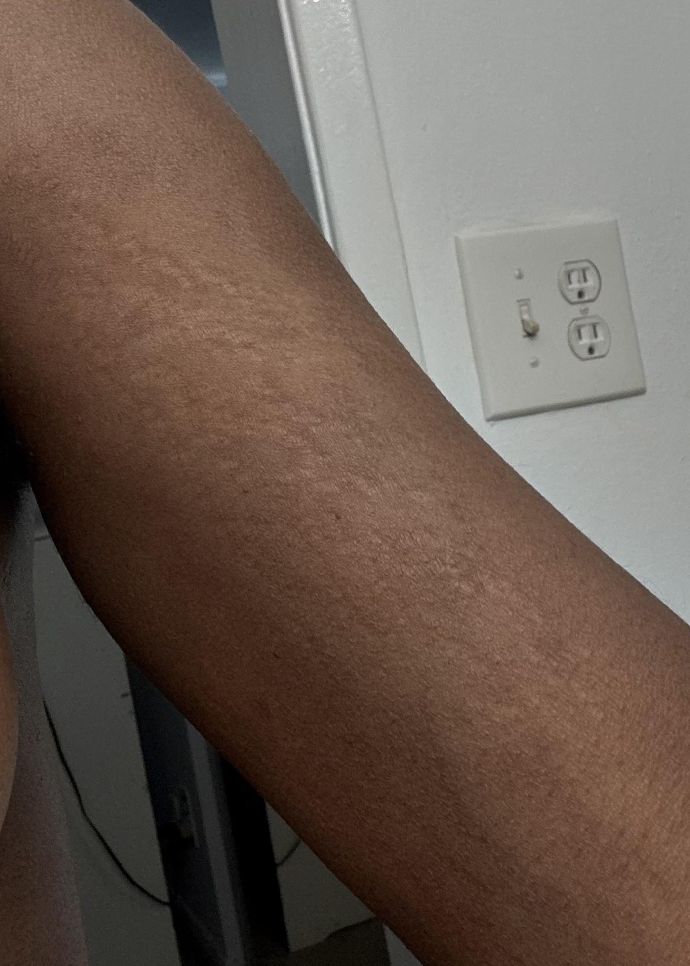 paramedical tattoo stretch mark camouflage vitiligo scar treatment discolored skin help in Long Beach Ca near Bellflower CA near Cypress CA orange county la county