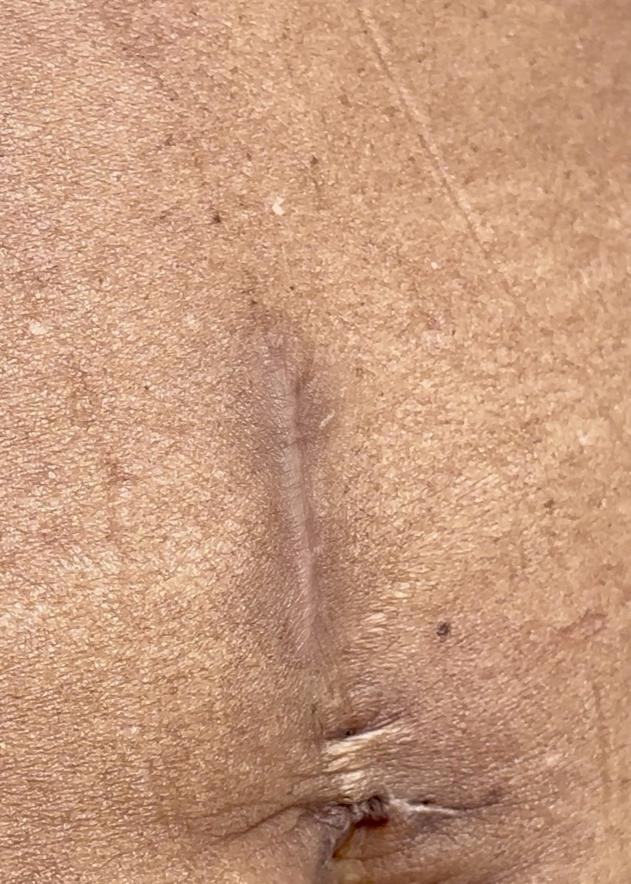 paramedical tattoo stretch mark camouflage vitiligo scar treatment discolored skin help in Long Beach Ca near Bellflower CA near Cypress CA orange county la county