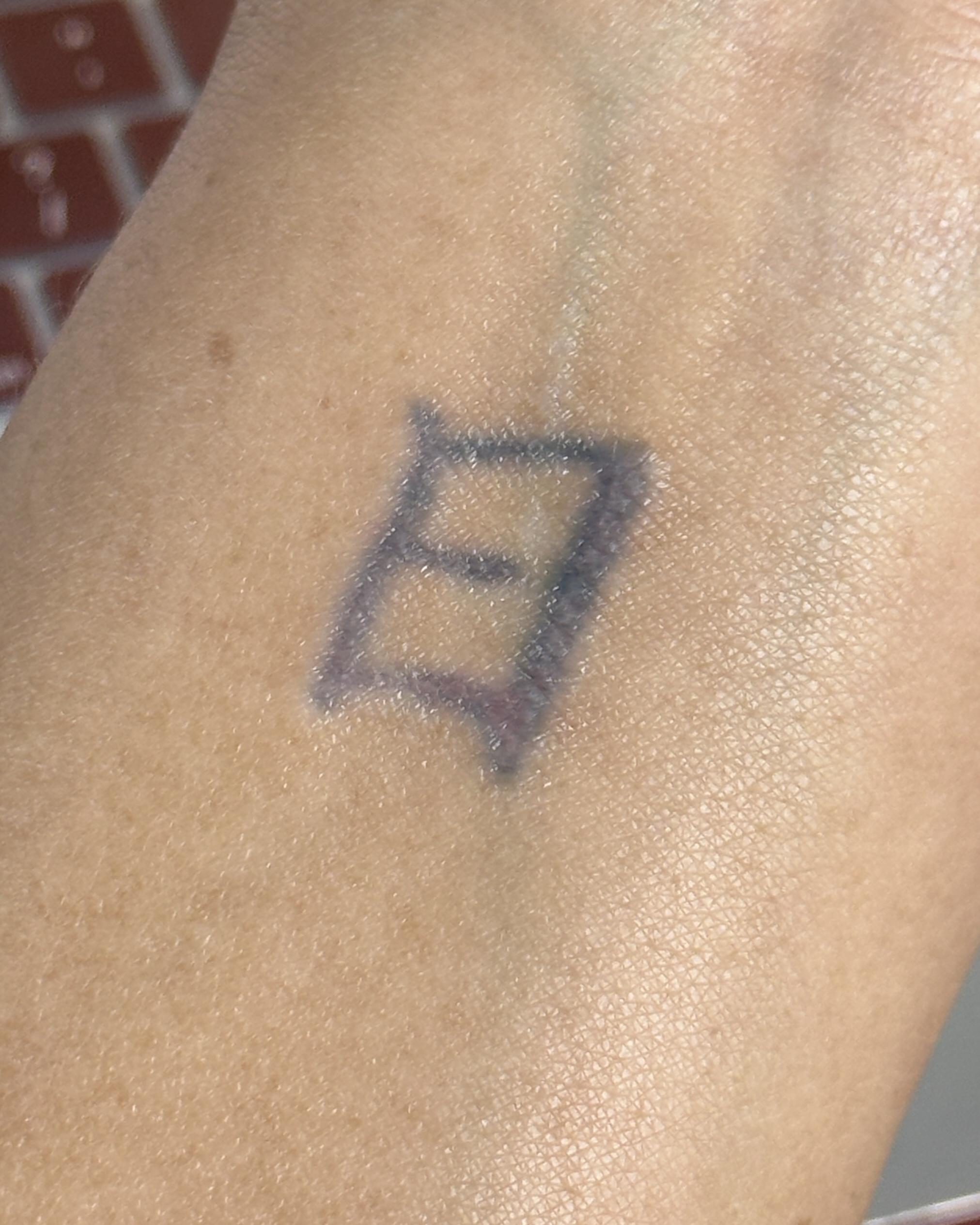 best emergency tattoo removal saline tattoo removal Permanent makeup removal near Bellflower CA in Long Beach CA