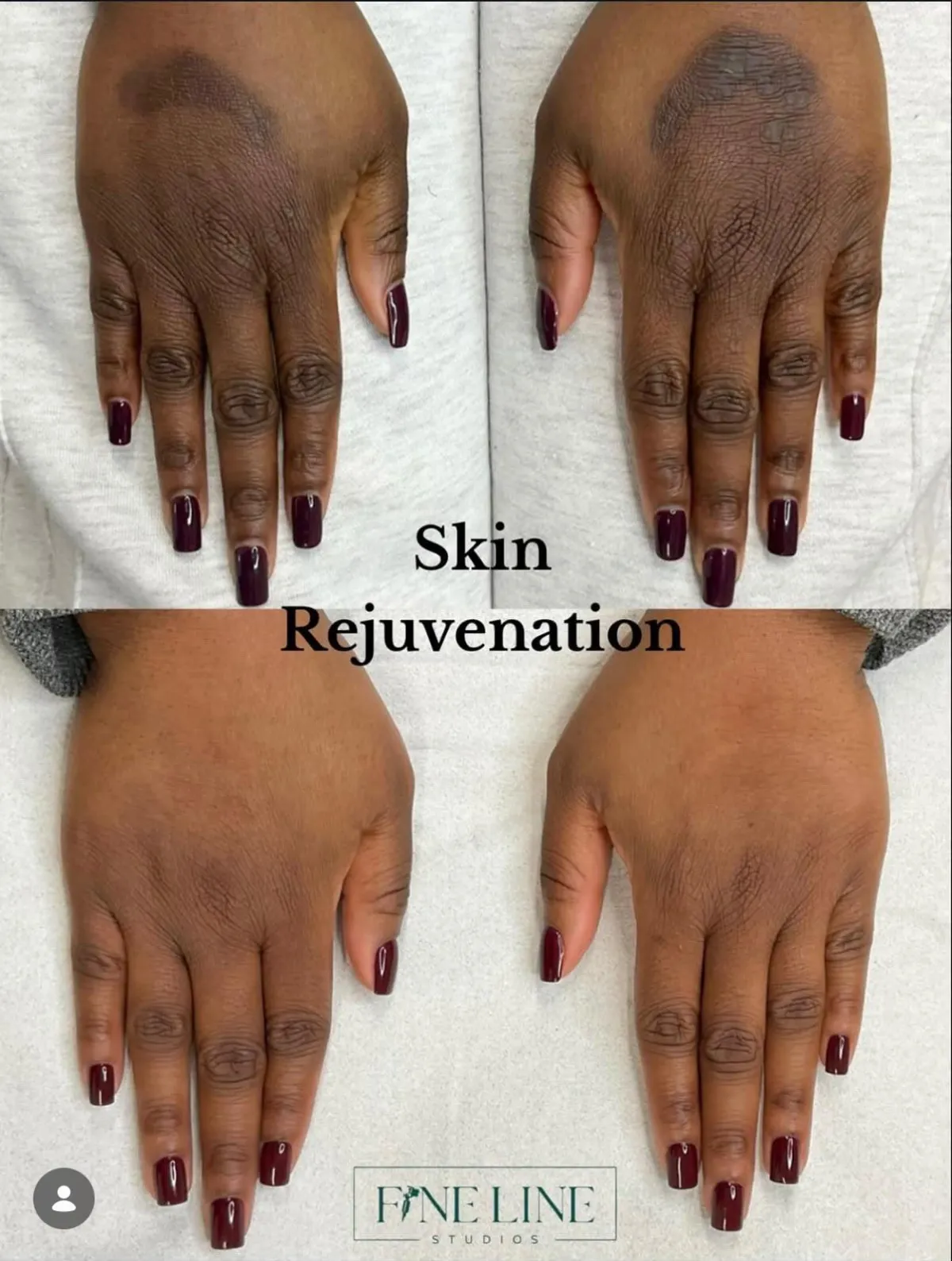 Client result before and after treatment