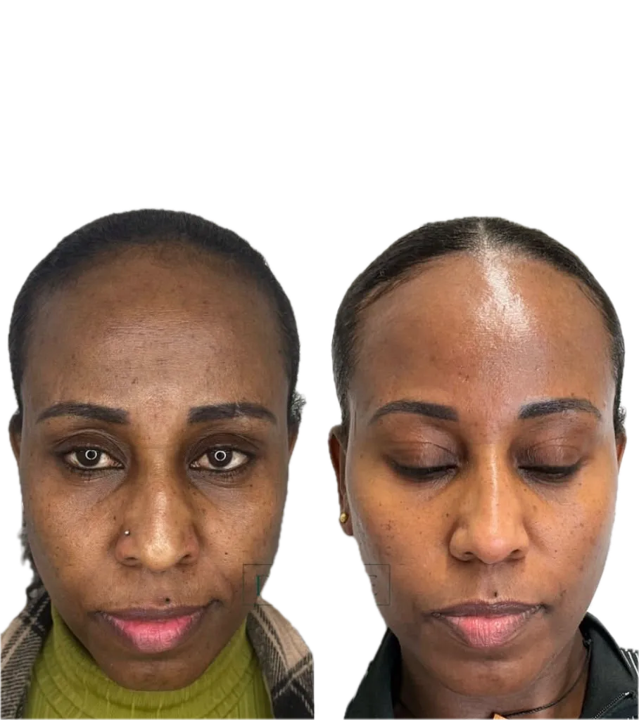 Client result before and after treatment
