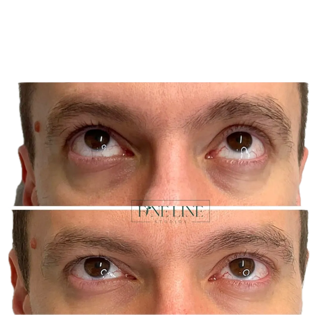 Client result before and after treatment