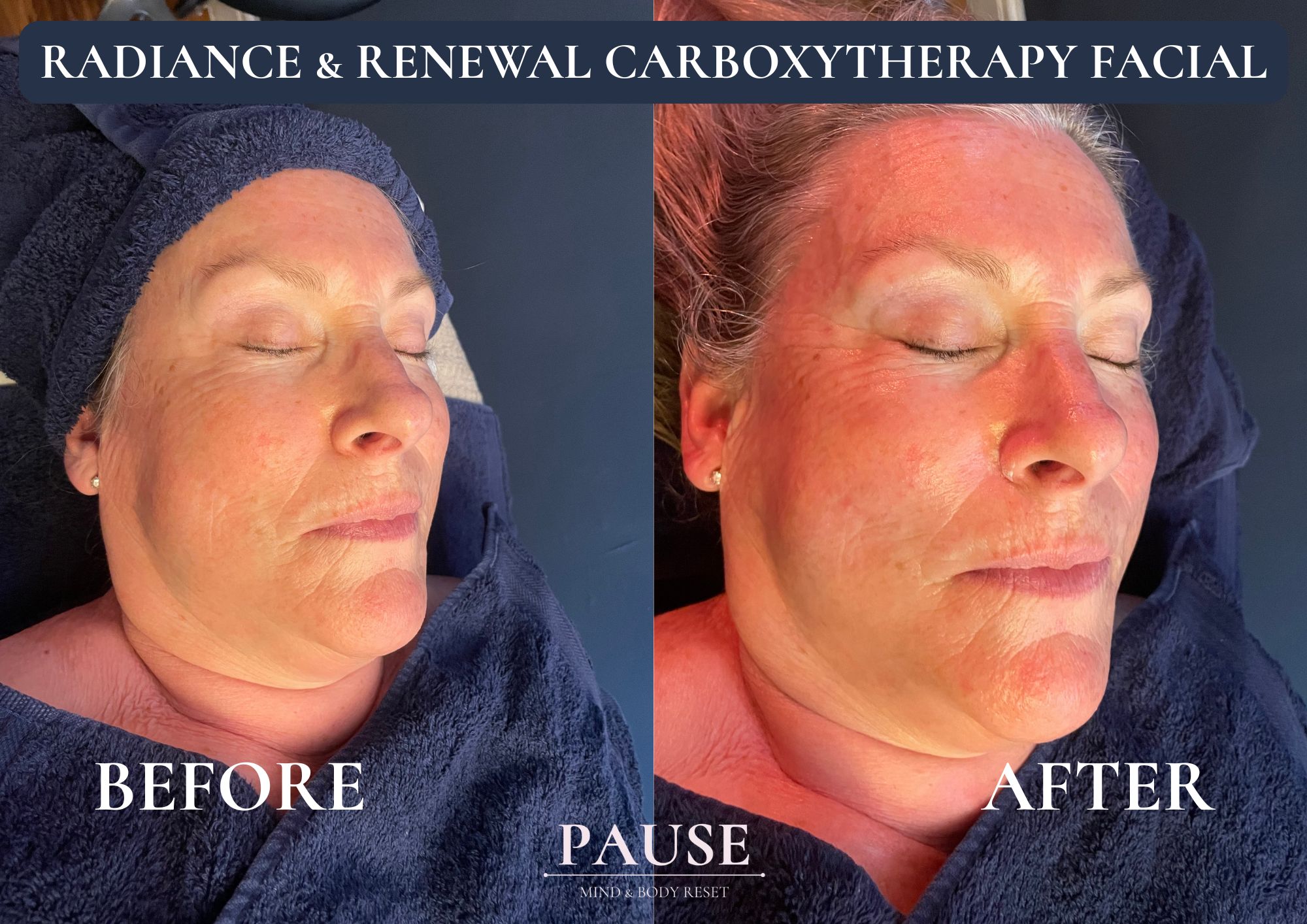 before and after of a cliniccare carboxytherapy facial