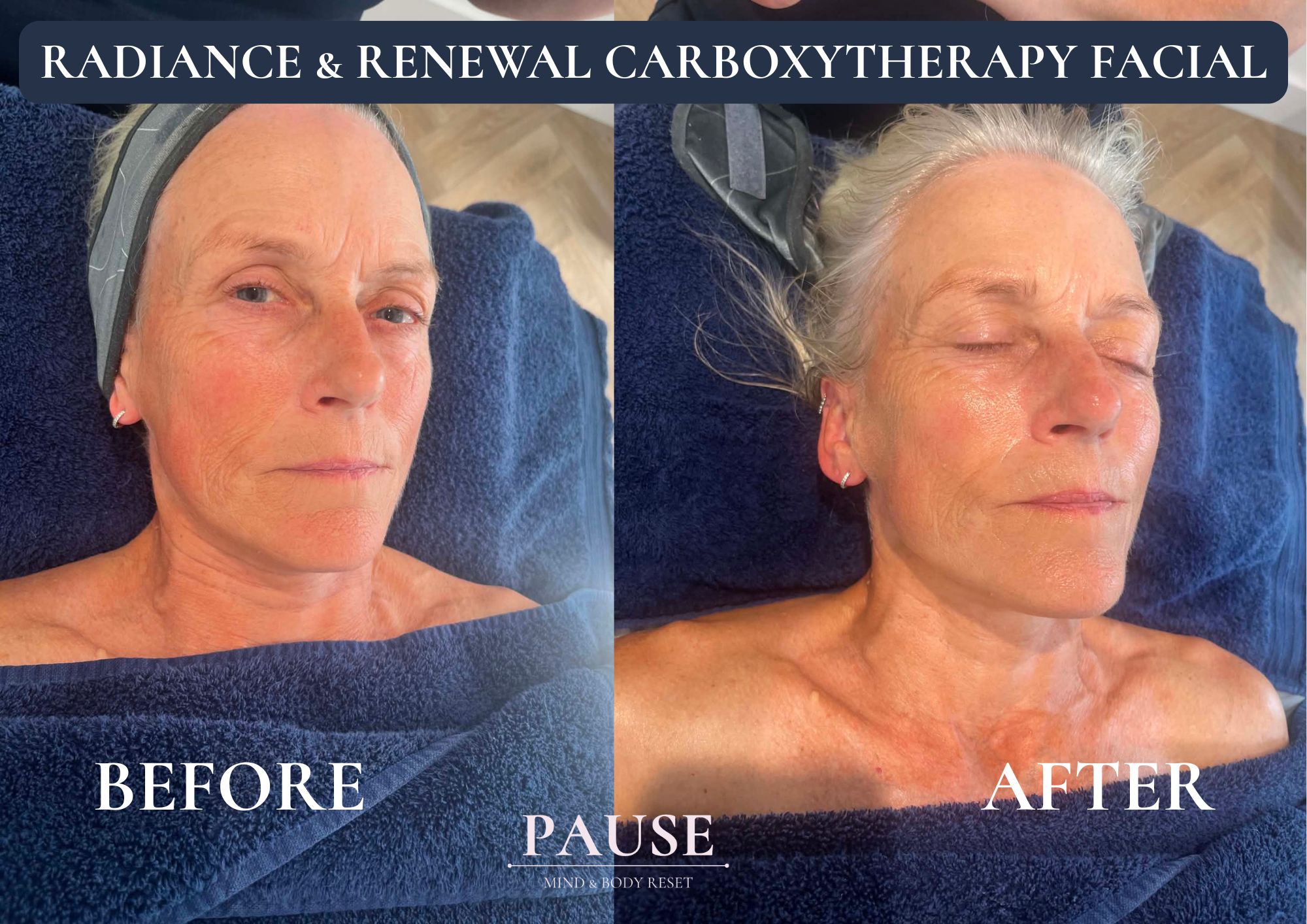 before and after of a cliniccare carboxytherapy facial