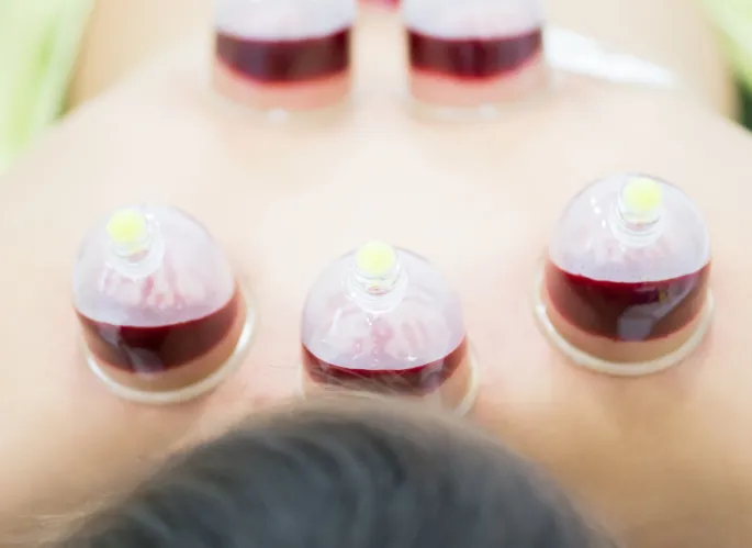 Glass cupping therapy on back