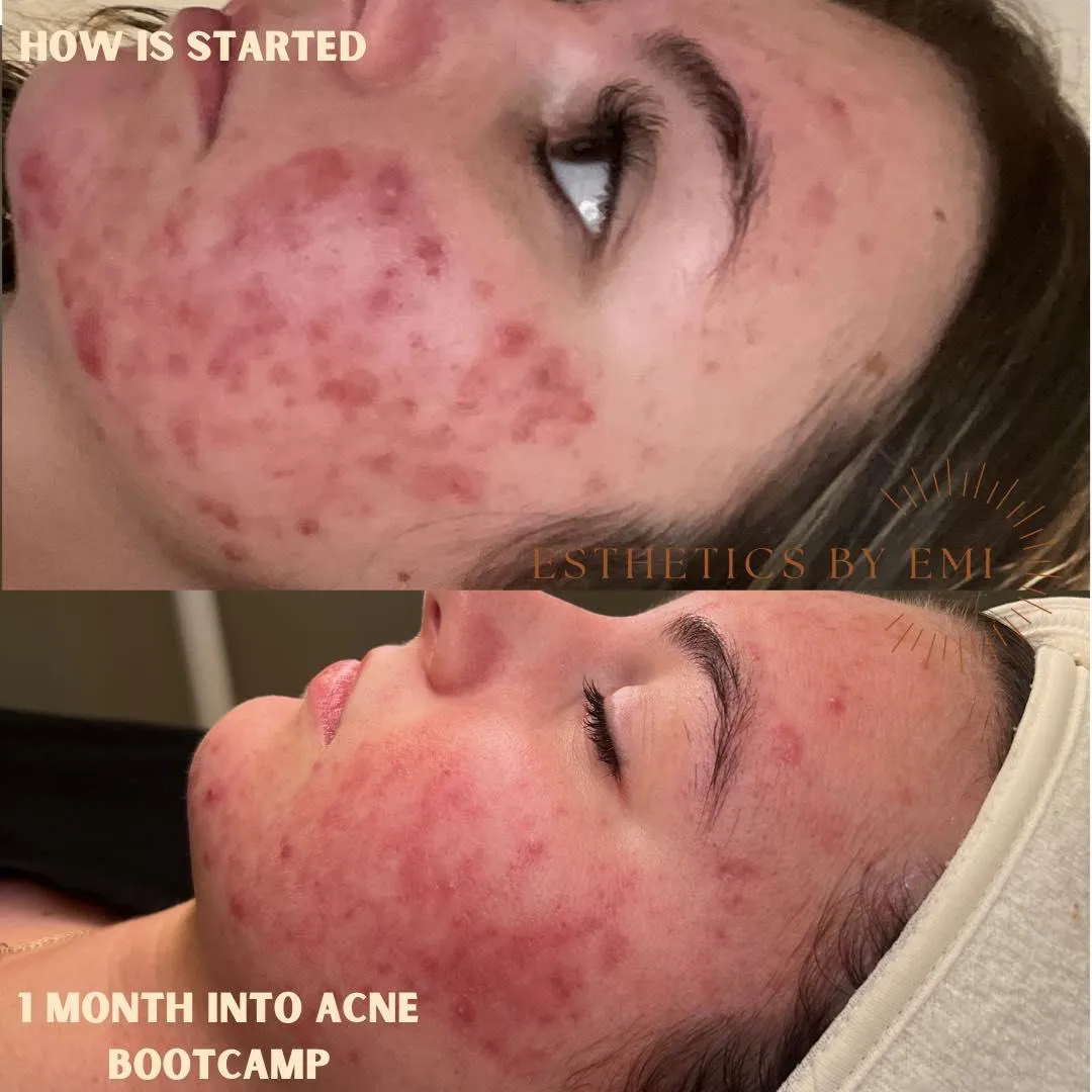 1 month acne bootcamp the sun room Cullman