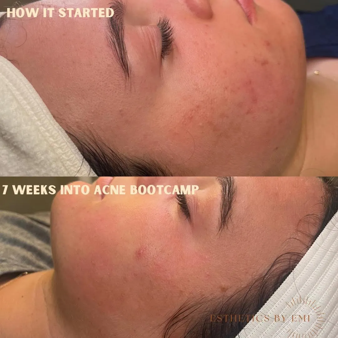 Acne bootcamp the Sun Room Cullman