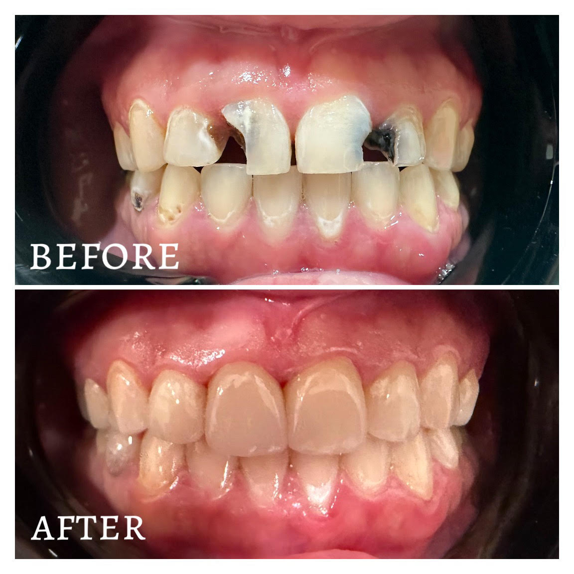 Smile makeover results in Citrus Park showing veneers and professional teeth whitening.
