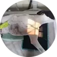 Shoulder Osteochondritis Dissecans (OCD)