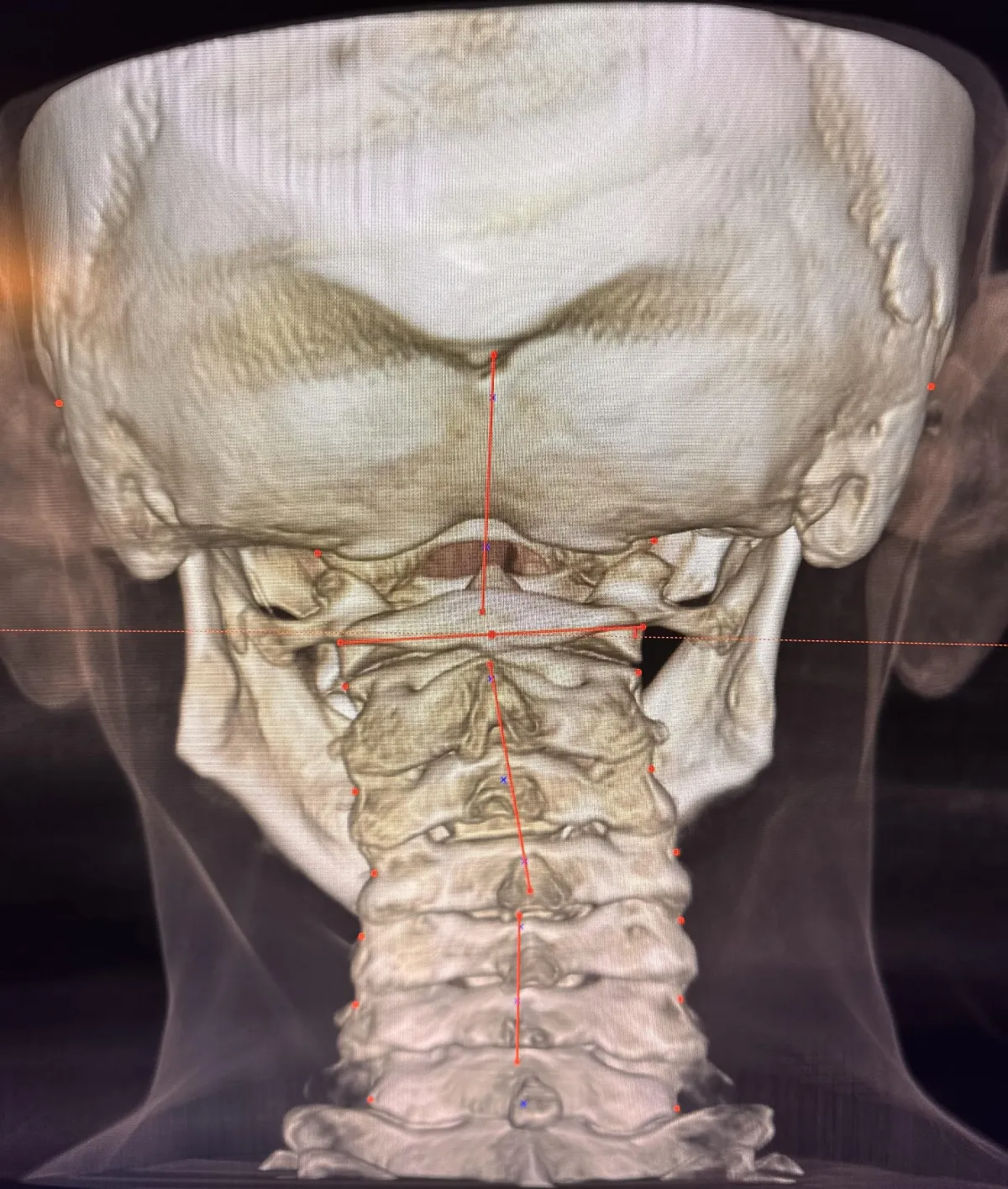 3D CBCT imaging of a patient with a head and neck mislignment.