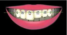 Teeth Align