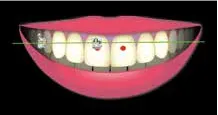 Teeth Align