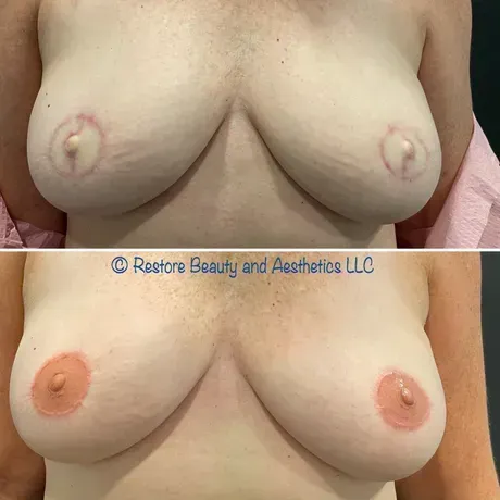 Areola Restoration