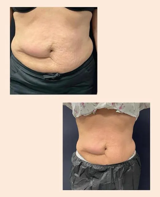emsculpt neo before and after men