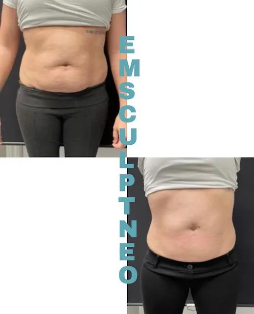 emsculpt before and after women