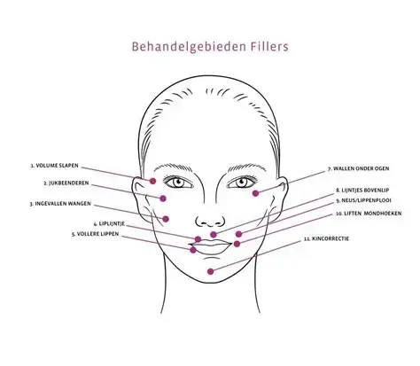 Natuurlijke lip- en jukbeenfiller behandeling bij Clinic3D Hasselt
