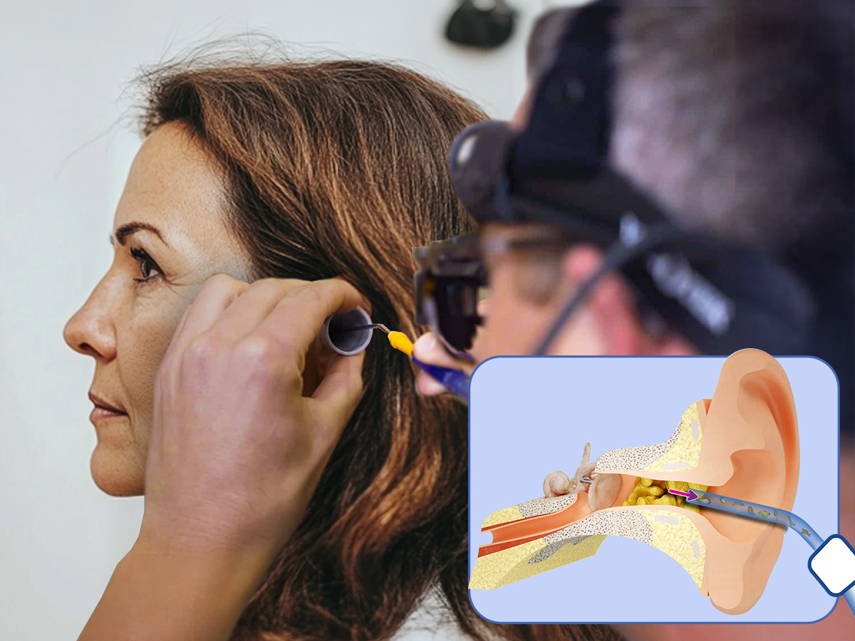 What is microsuction earwax removal?