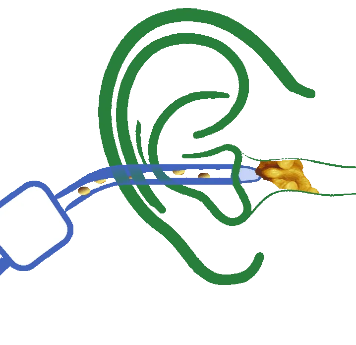 microsuction earwax removal