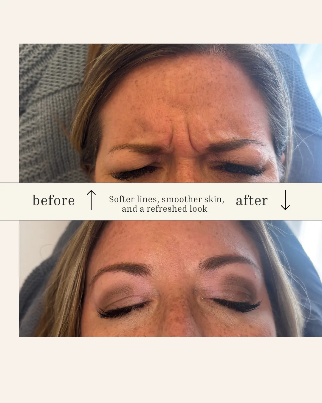 Before and After Wrinkle Relaxer Results in Prescott, AZ (Natural-Looking Results)