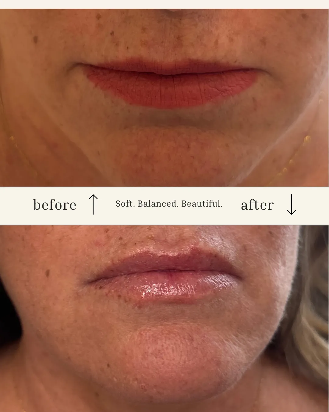 Lip Filler Before and After in Prescott, AZ (Soft, Natural Results)