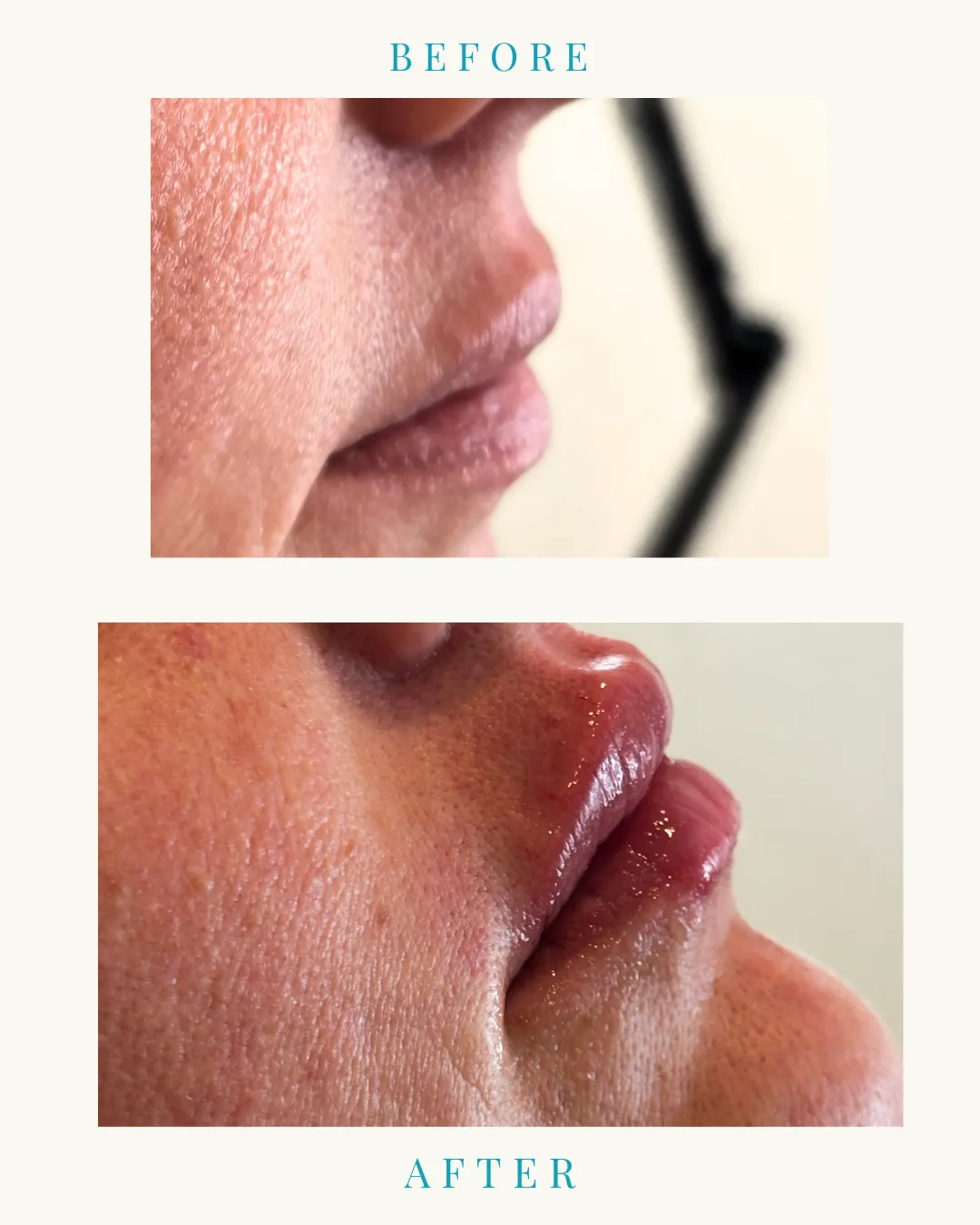 Lip Filler Before and After: A Natural Approach