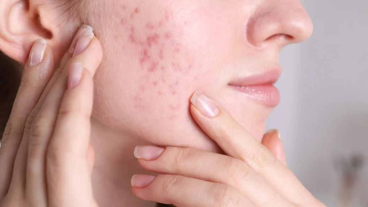 Hormonal Acne vs Gut Acne | Signs, Causes, and Skin Health Guide