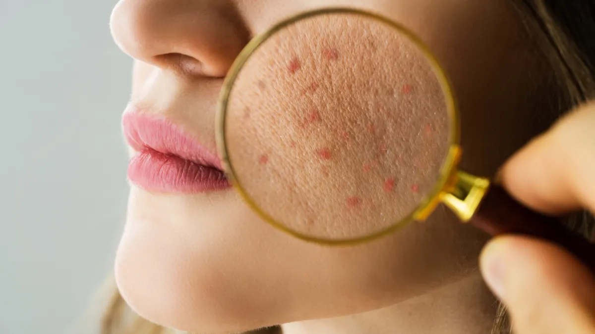 3 Signs Your Skin Issues Are Actually Coming from Your Gut