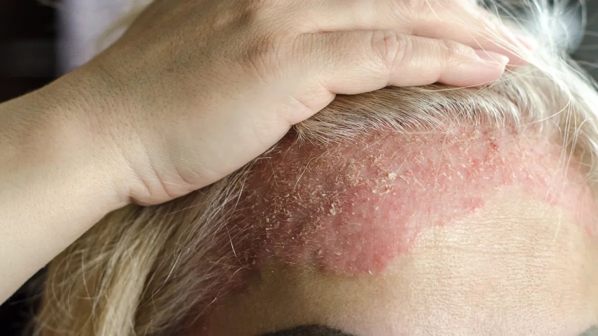 Eczema That Won't Go Away? Why We Need to Look at Your Hormones