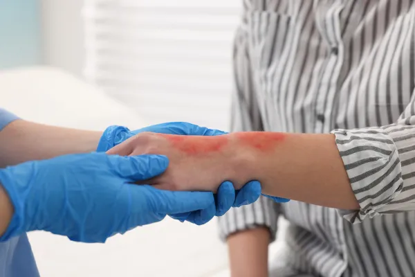 Medical Recovery After Burn Accidents
