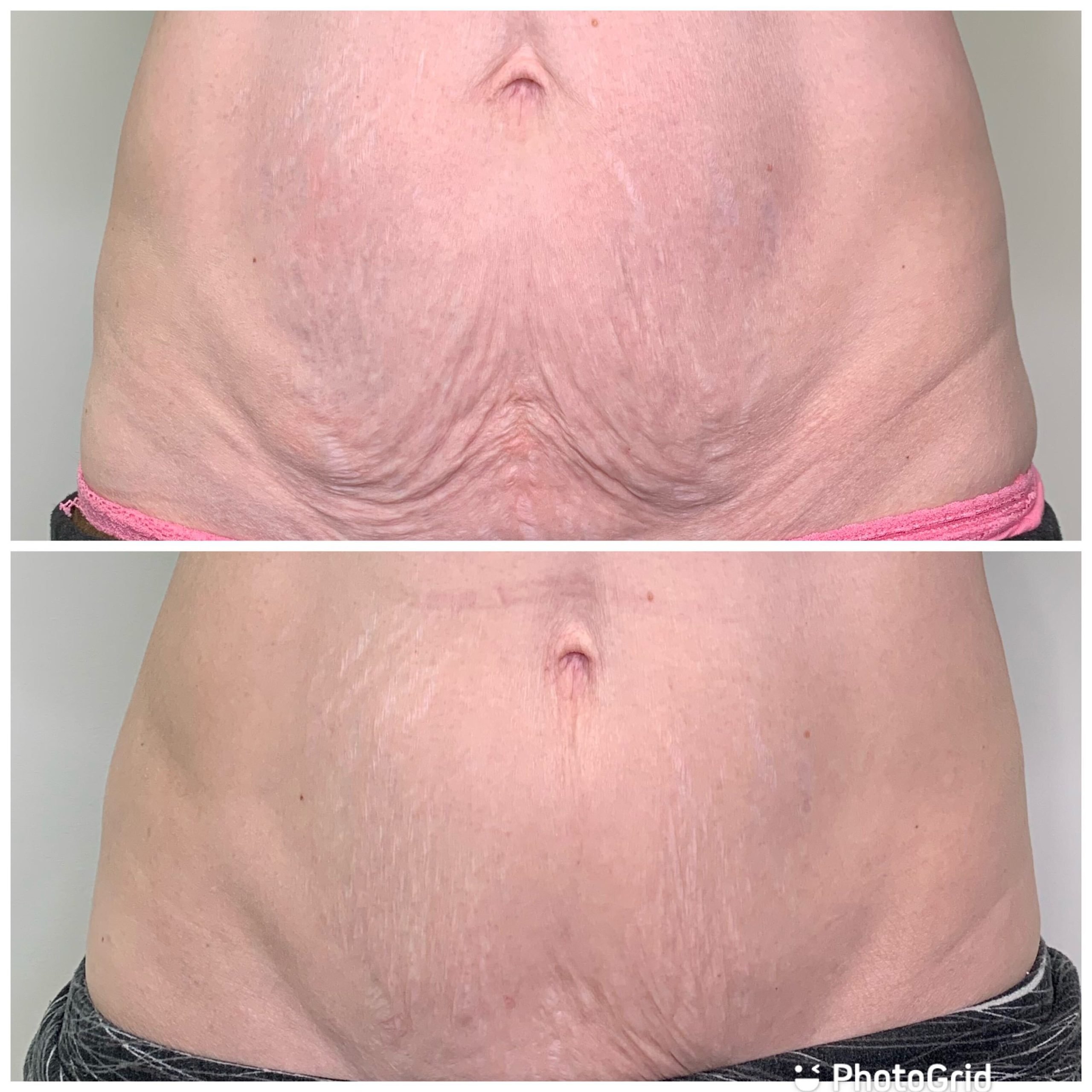 Abdomen treatment area