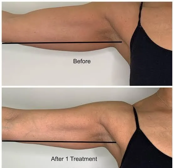 Arms treatment area