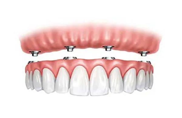Full-Mouth Implant